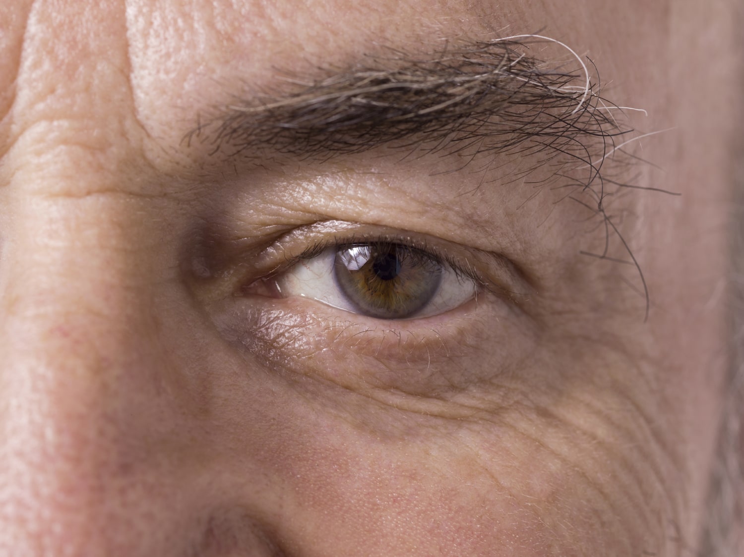 droopy-upper-eyelid-conditions-and-cures-alpine-eye-care