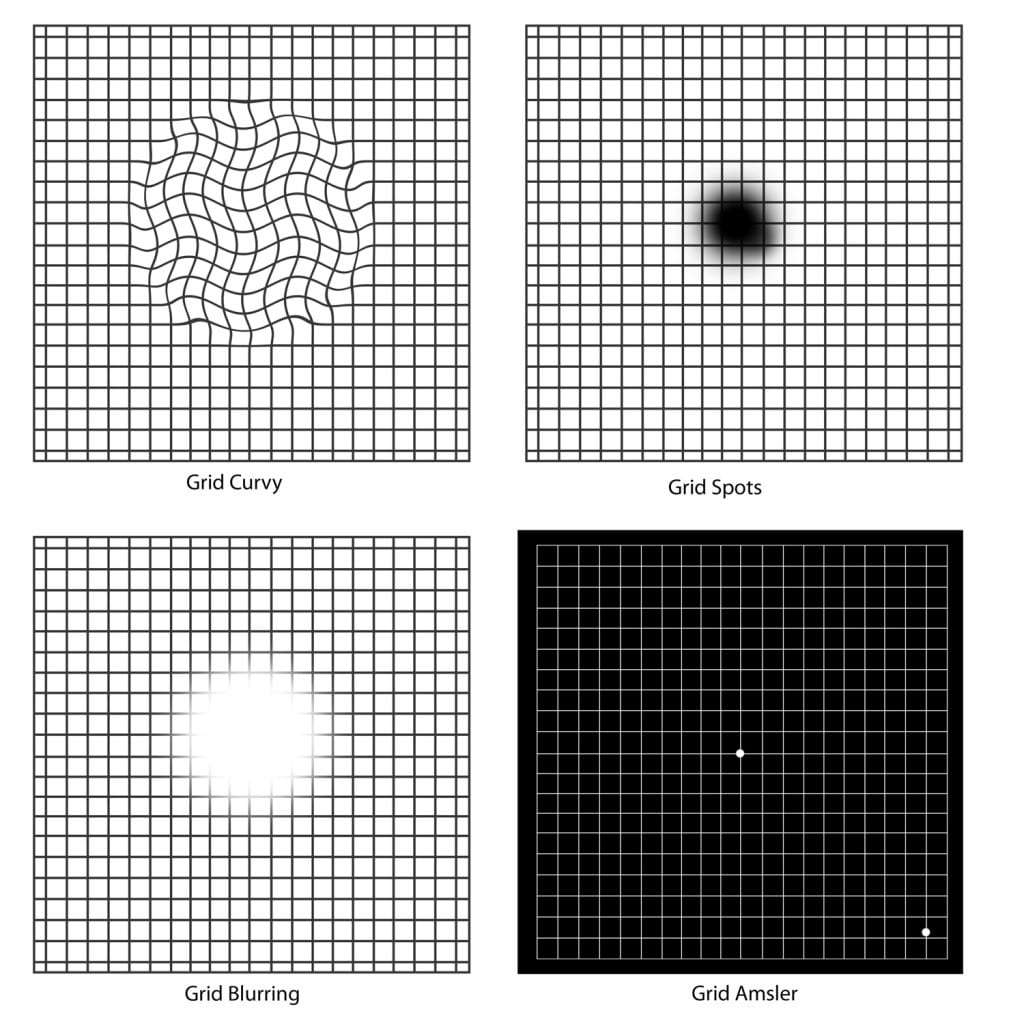 Amsler Grid Test  Retina Specialists of North Alabama, LLC