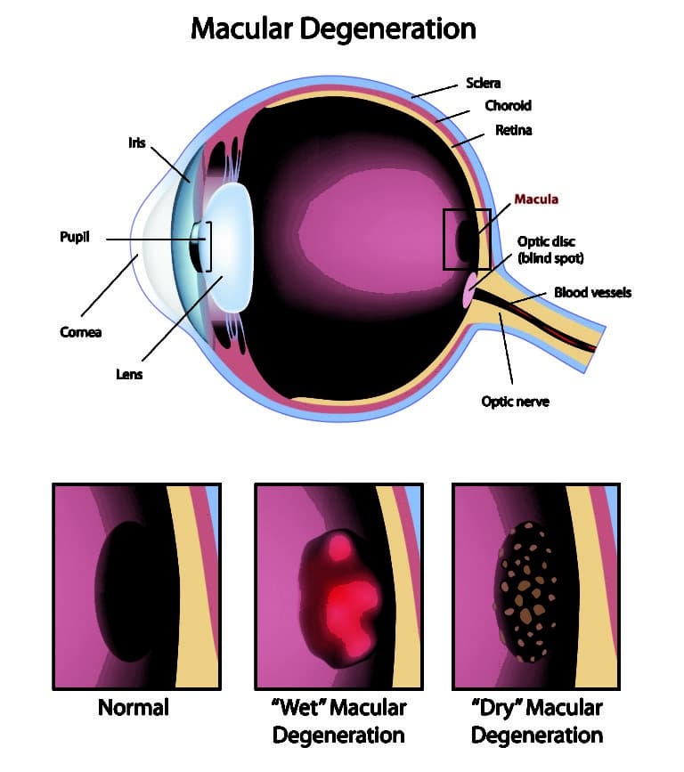 Macular Degeneration Can Be Scary but Alpine Eye Care Will Provide the ...